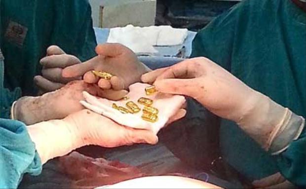 Các chuyên gia phẫu thuật rốt cuộc phát hiện, trong dạ dày của bệnh nhân lớn tuổi không có nắp chai nước. Thay vào đó là 12 thỏi vàng với trọng lượng mỗi thỏi là 33g và có tổng trị giá lên tới 23.300 USD.